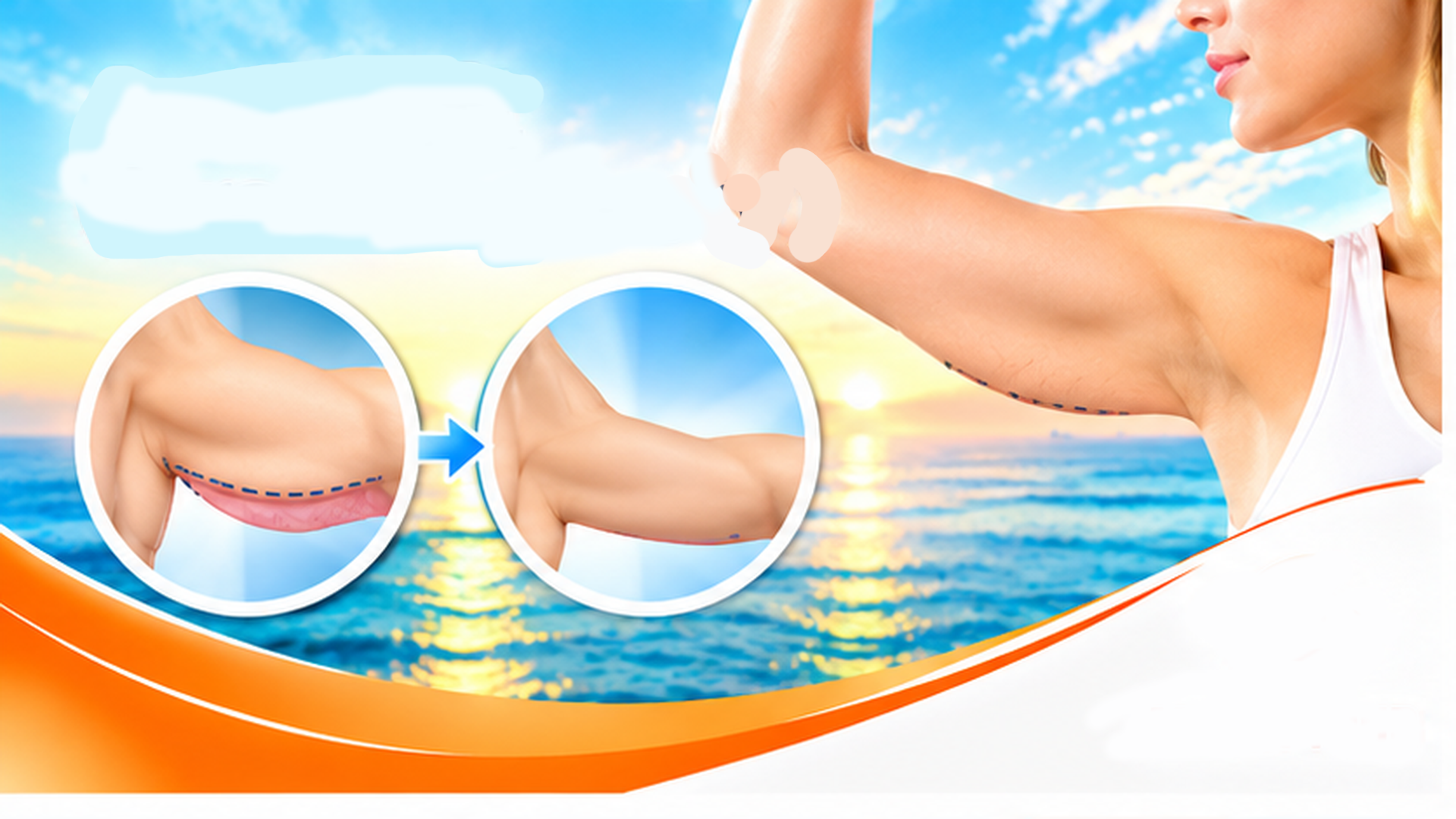Arm Lift (Brachioplasty)