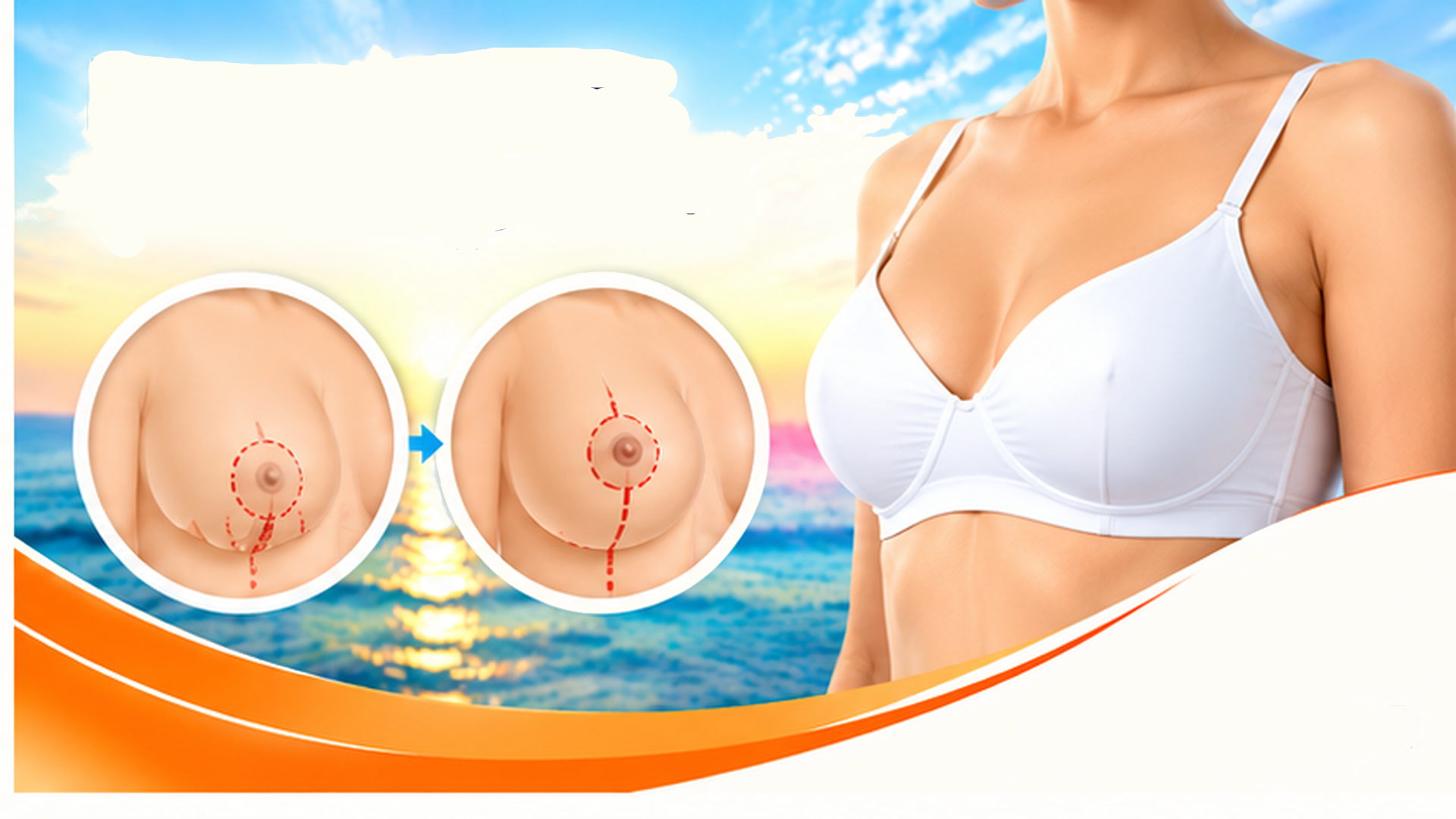 Breast Lift (Mastopexy)