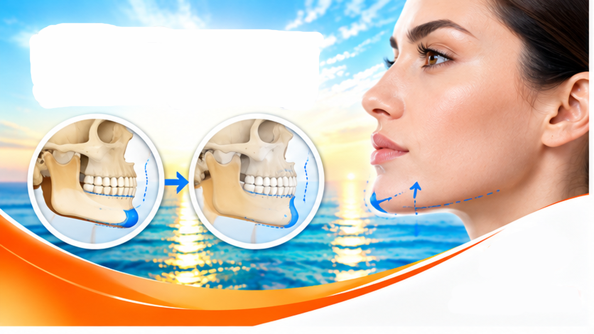 Chin Surgery (Genioplasty)
