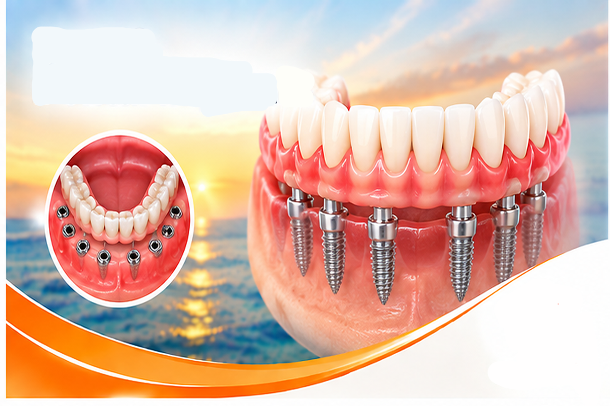 3-on-6 Dental Implants