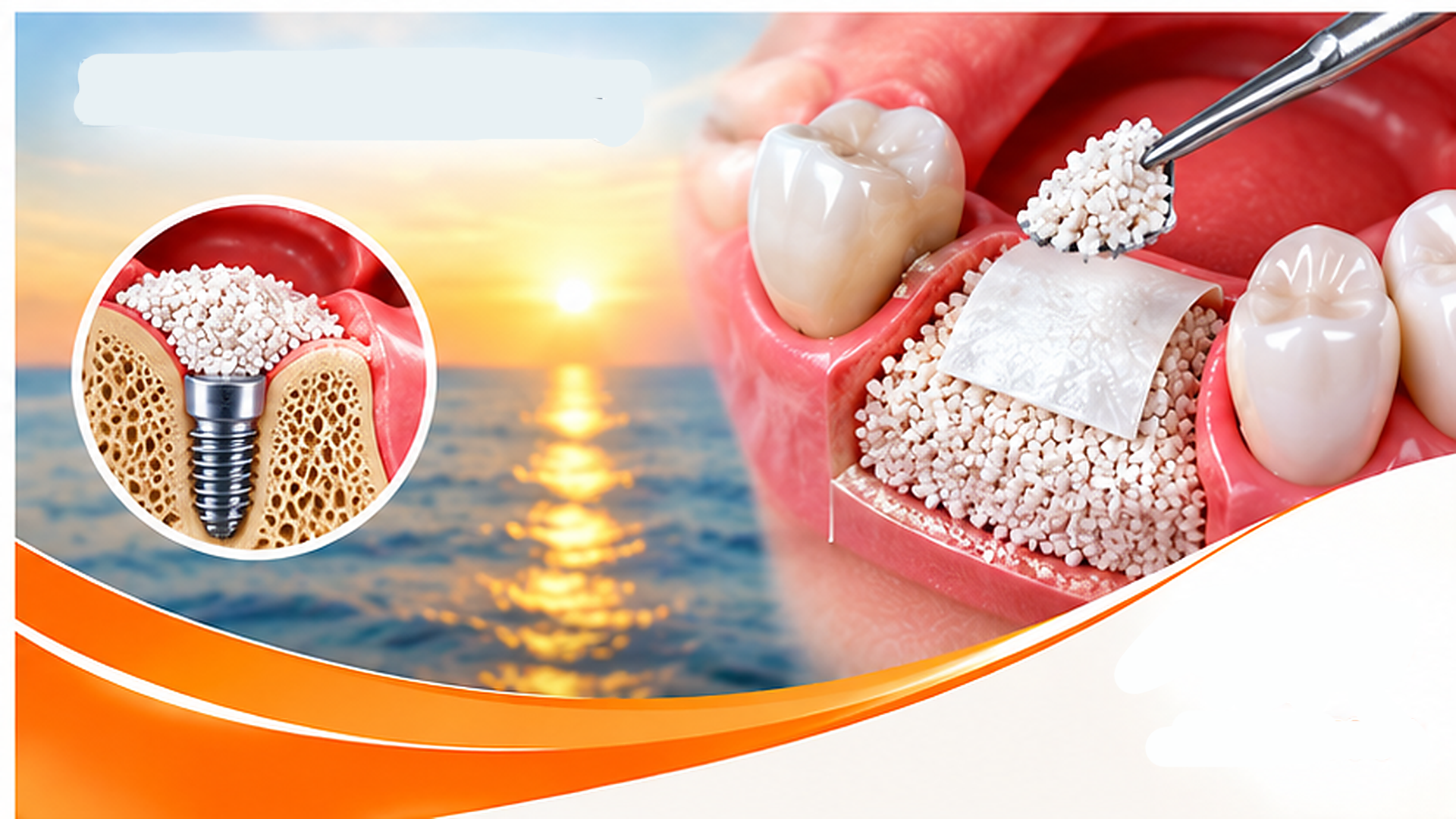 Bone Grafting